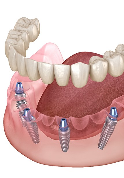 A model of an all-on-4 denture