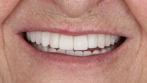 A woman’s smile before and after all-on-4