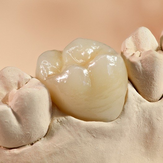 Model smile with dental crown restoration