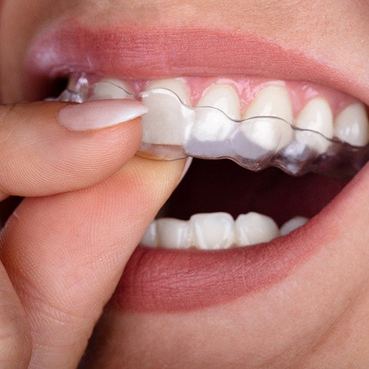 a closeup of a patient wearing a clear aligner