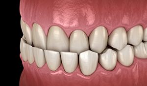 Illustrated mouth with an underbite