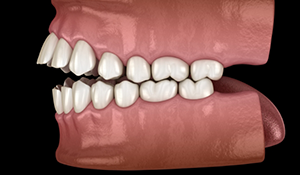 Illustrated mouth with an open bite