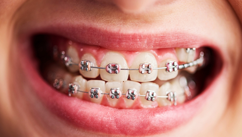 Smile with traditional braces