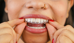 Close up of a person placing a clear aligner over their teeth