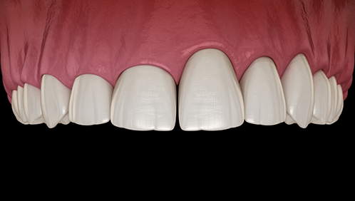 Illustration of a mouth with an uneven gumline