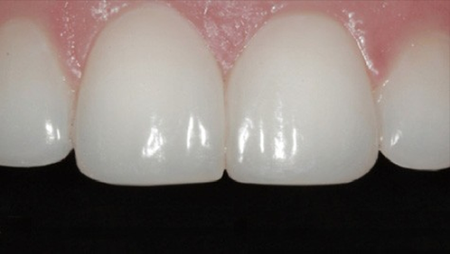 Close up of a flawless row of upper teeth
