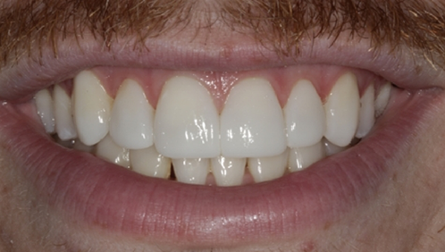 Close up of a man smiling with flawless teeth