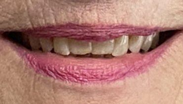 Discolored teeth before cosmetic dentistry