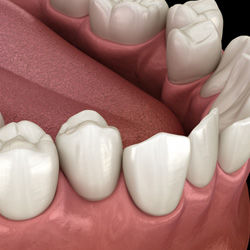 Illustration of crooked teeth