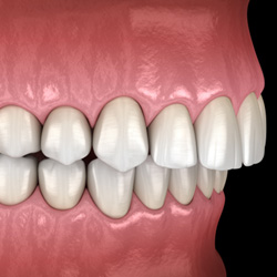 Illustration of an overbite