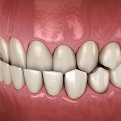 Illustration of an underbite