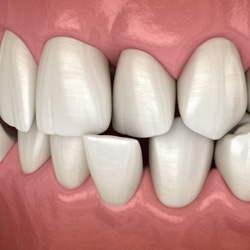 Illustration of a crossbite