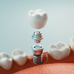 Diagram showing parts of dental implants in Summerfield