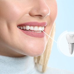 woman smiling with dental implant in mouth   