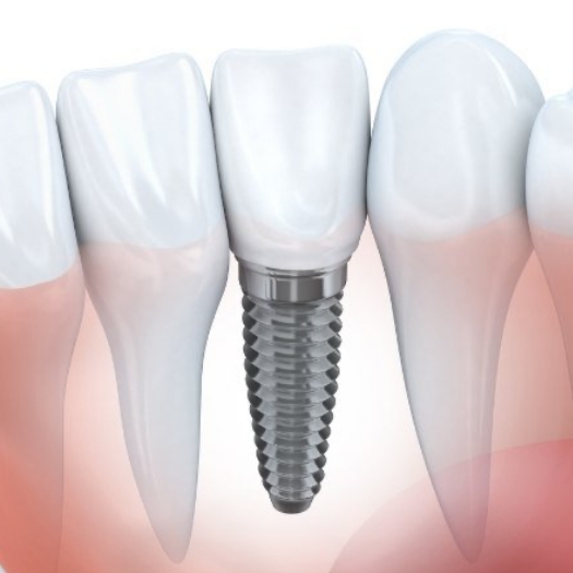 Animated dental implant supported dental crown