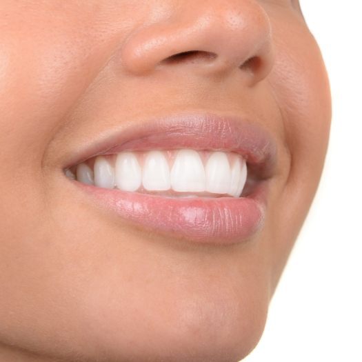 Flawless smile after dental implant tooth replacement