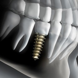 Animated smile with dental implant supported dental crown in place