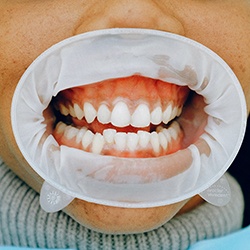 Woman at consultation for Invisalign