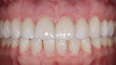 Close up of beautiful teeth after treatment