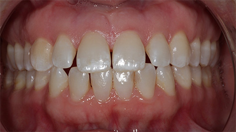 Close up of flawed teeth before treatment