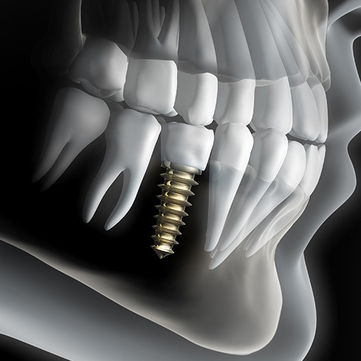 Animated dental implant supported dental crown