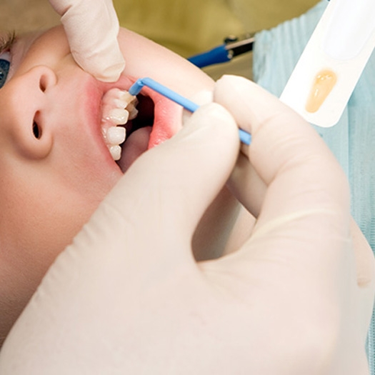 Child receiving fluoride treatment