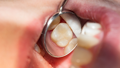 Dental mirror in a mouth reflecting the teeth