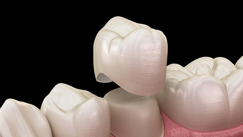 Illustrated dental crown being fitted over a tooth