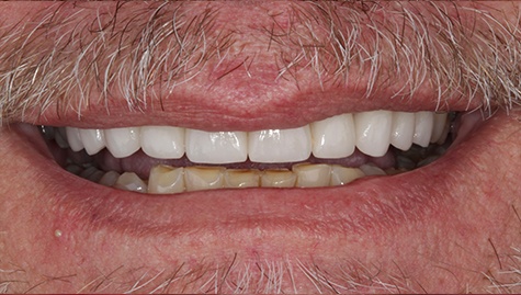 Man with whiter upper teeth