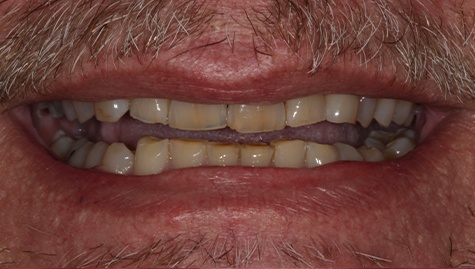 Man with discolored upper teeth