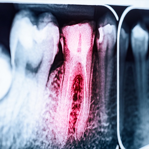Digital x-ray of tooth prior to root canal treatment