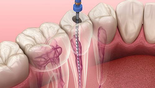 Illustration of root canal treatment being performed on a tooth