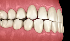 Illustrated mouth with a slight overbite