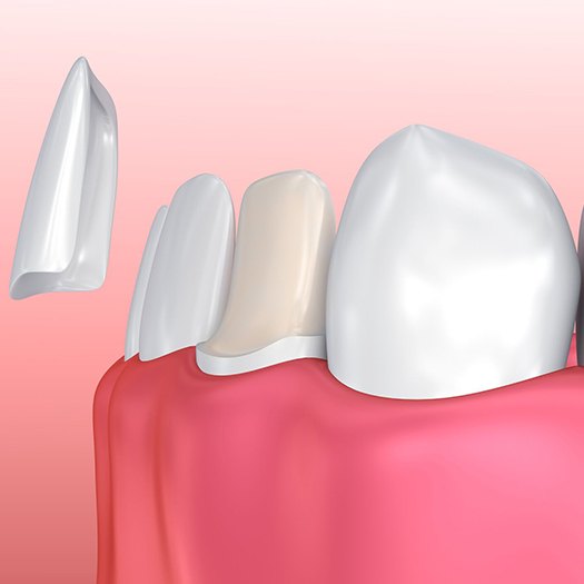 diagram of veneer being placed on bottom front tooth 