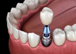 Parts of a dental implant for a lower tooth
