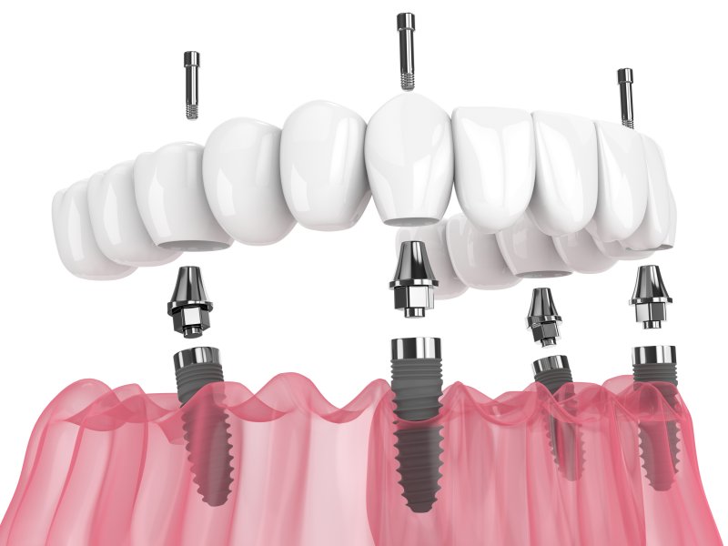 implant dentures