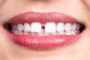 Close up of a patient’s diastema