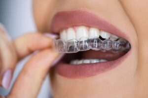 Person fitting clear aligner on to teeth. 
