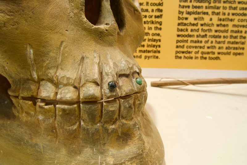 Ancient bone with cosmetic dental improvements